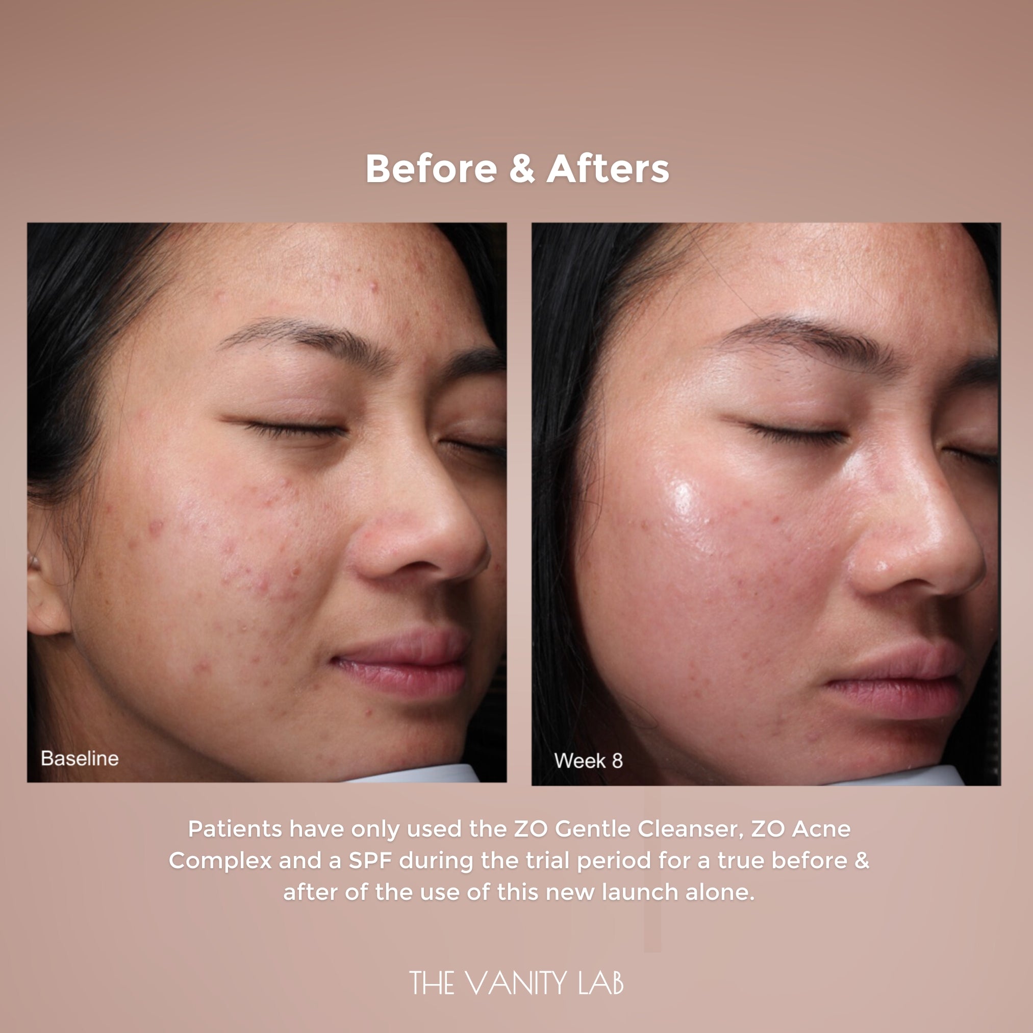 ZO Acne Complex - Image 5