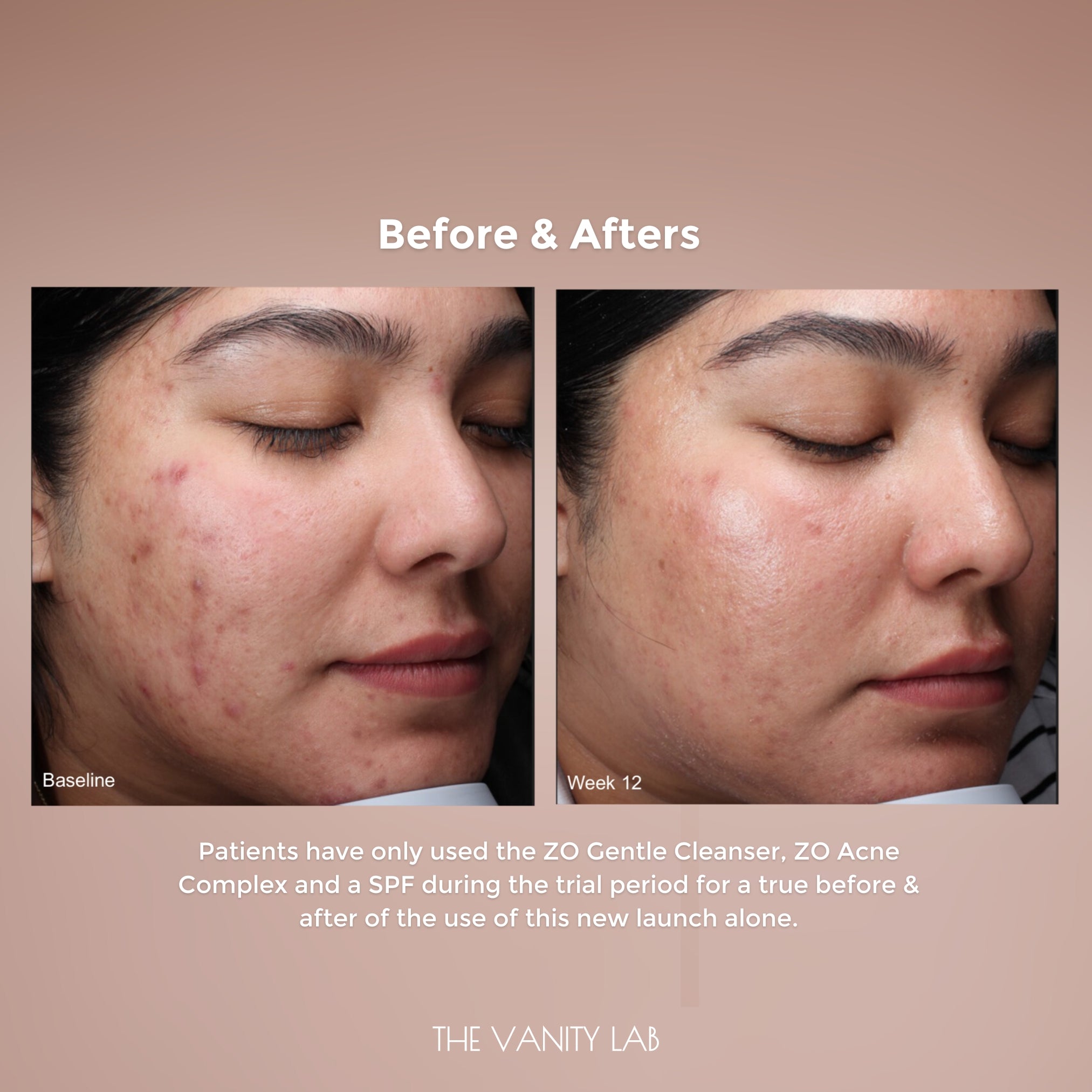 ZO Acne Complex - Image 8